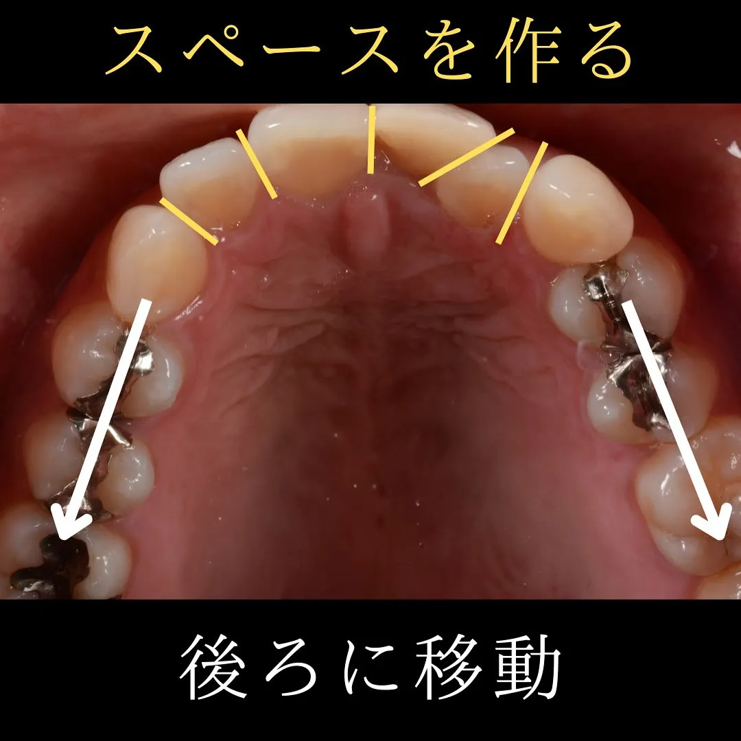 🦷インビザライン治療症例🦷