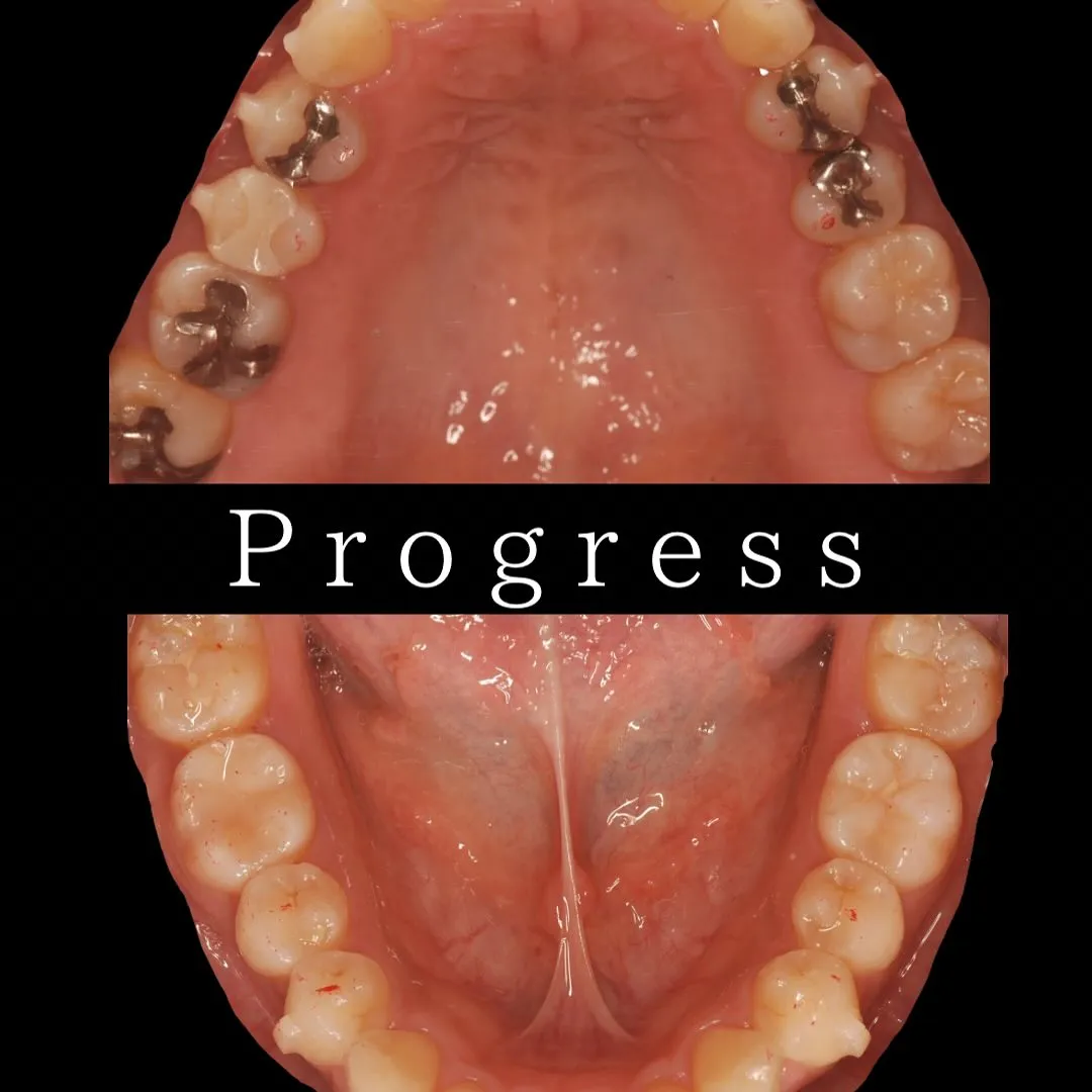 🦷インビザライン治療症例🦷