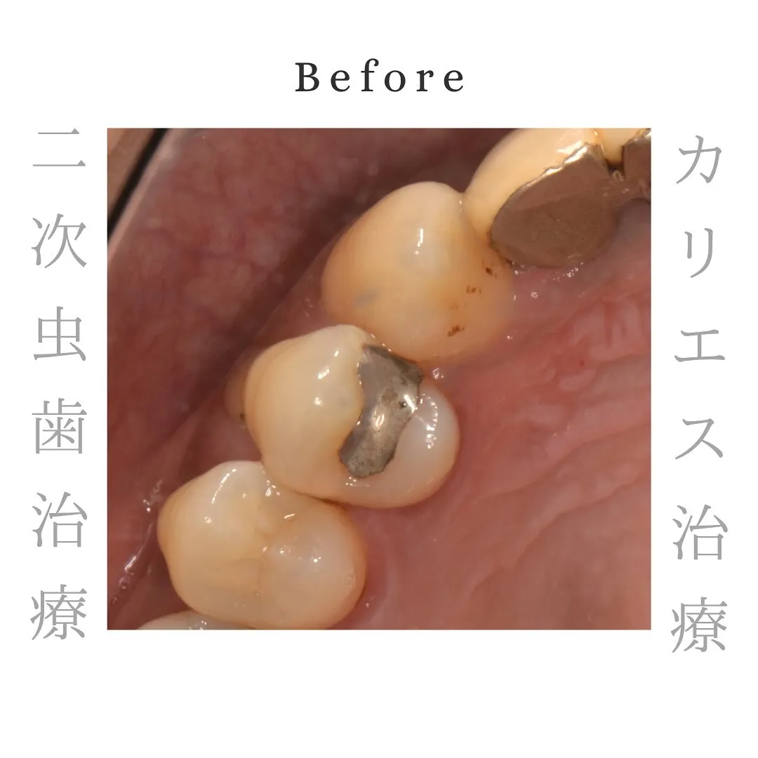 🦷隠れた虫歯🦷