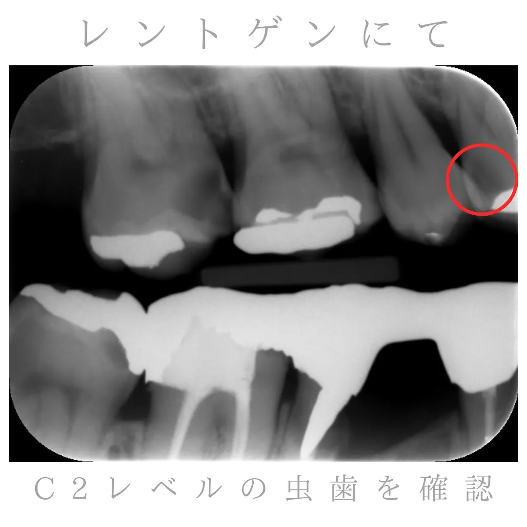🦷隠れた虫歯🦷