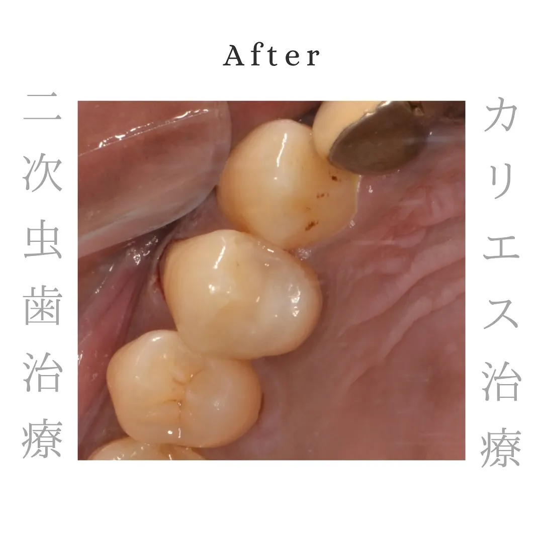 🦷隠れた虫歯🦷