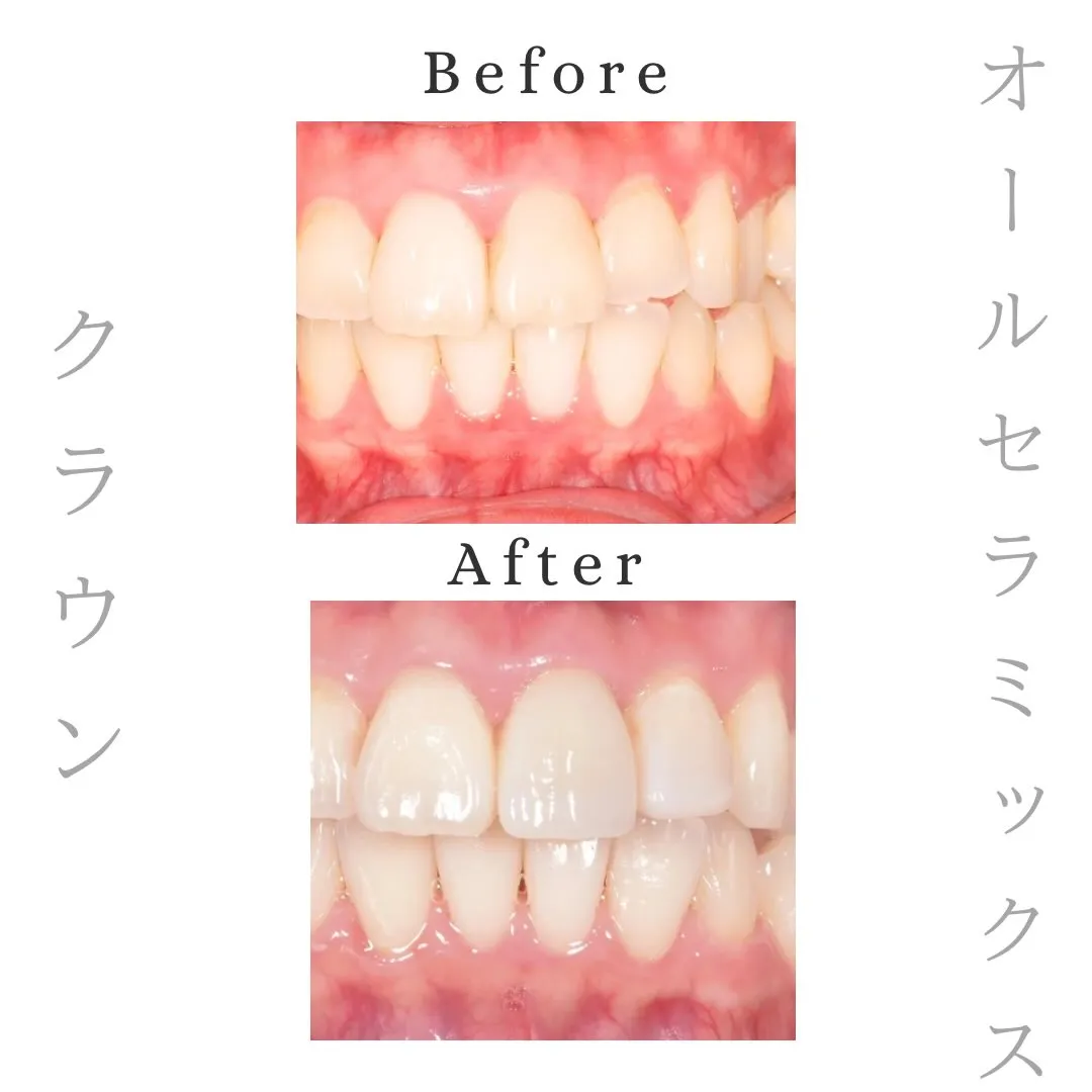 症例紹介｜オールセラミックス