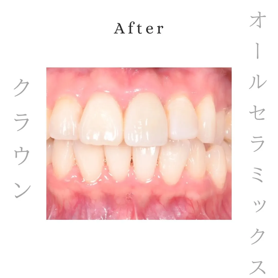 症例紹介｜オールセラミックス