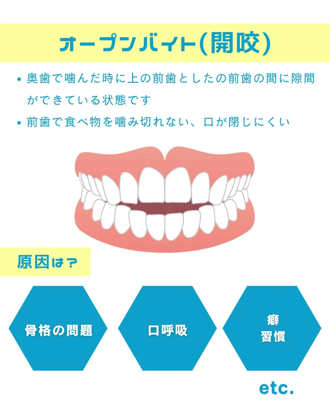 【意外と知らない！？歯並びの種類と原因①】