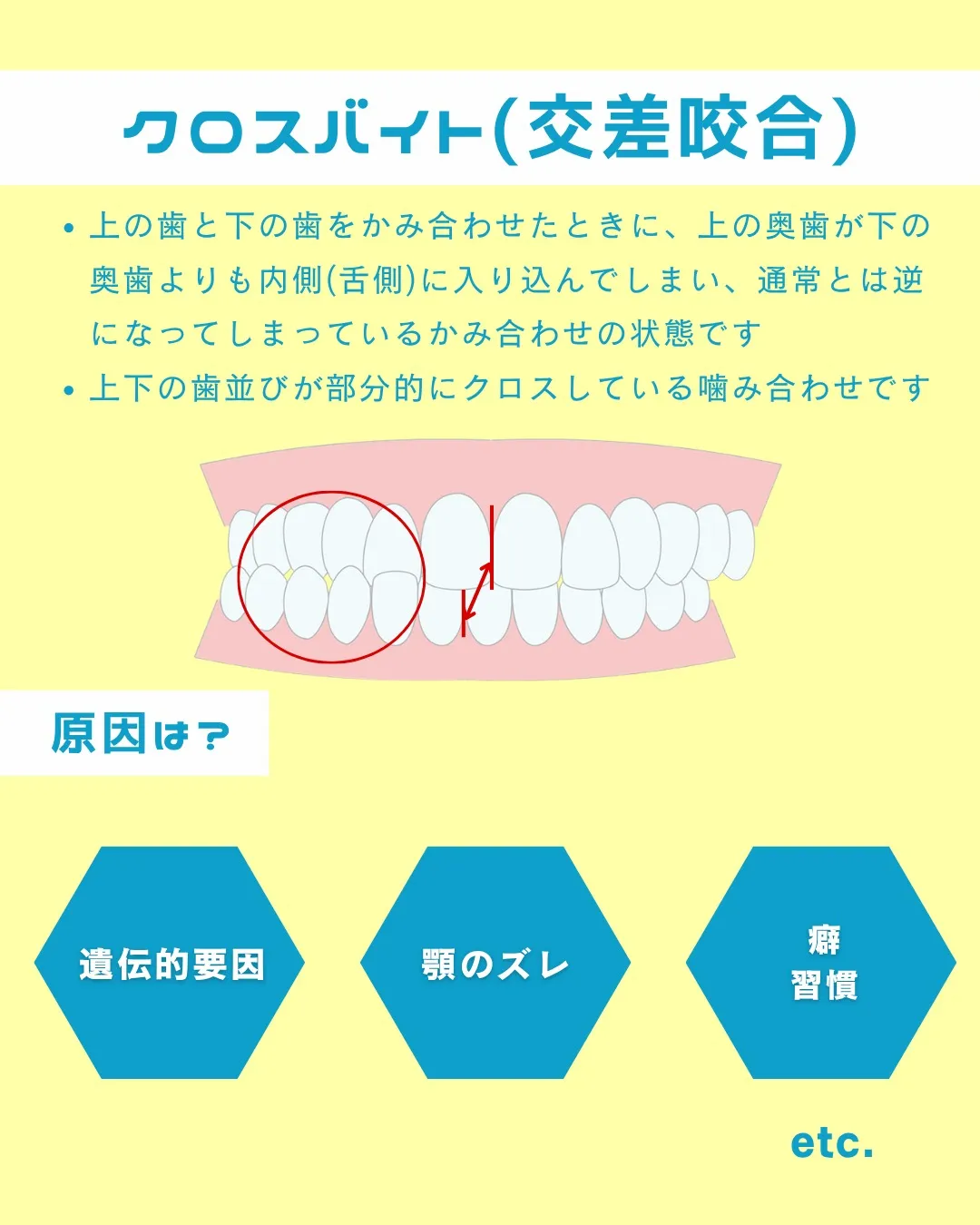 【意外と知らない！？歯並びの種類と原因①】