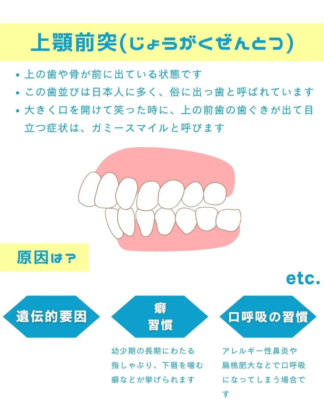 【意外と知らない！？歯並びの種類と原因②】