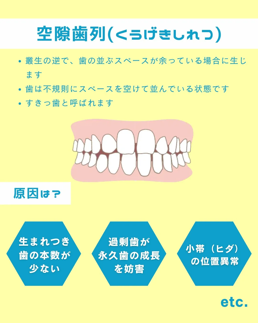【意外と知らない！？歯並びの種類と原因②】