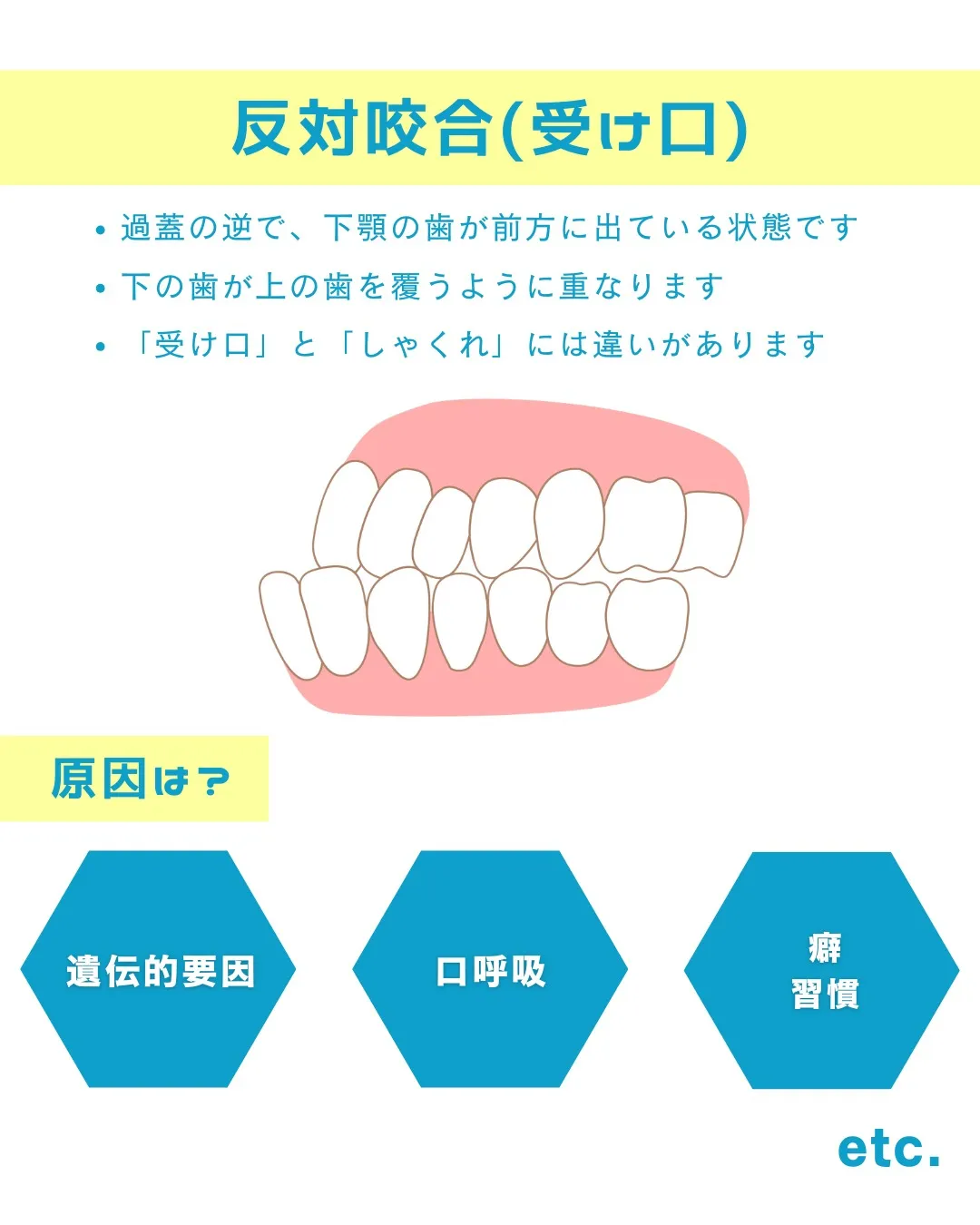 【意外と知らない！？歯並びの種類と原因②】