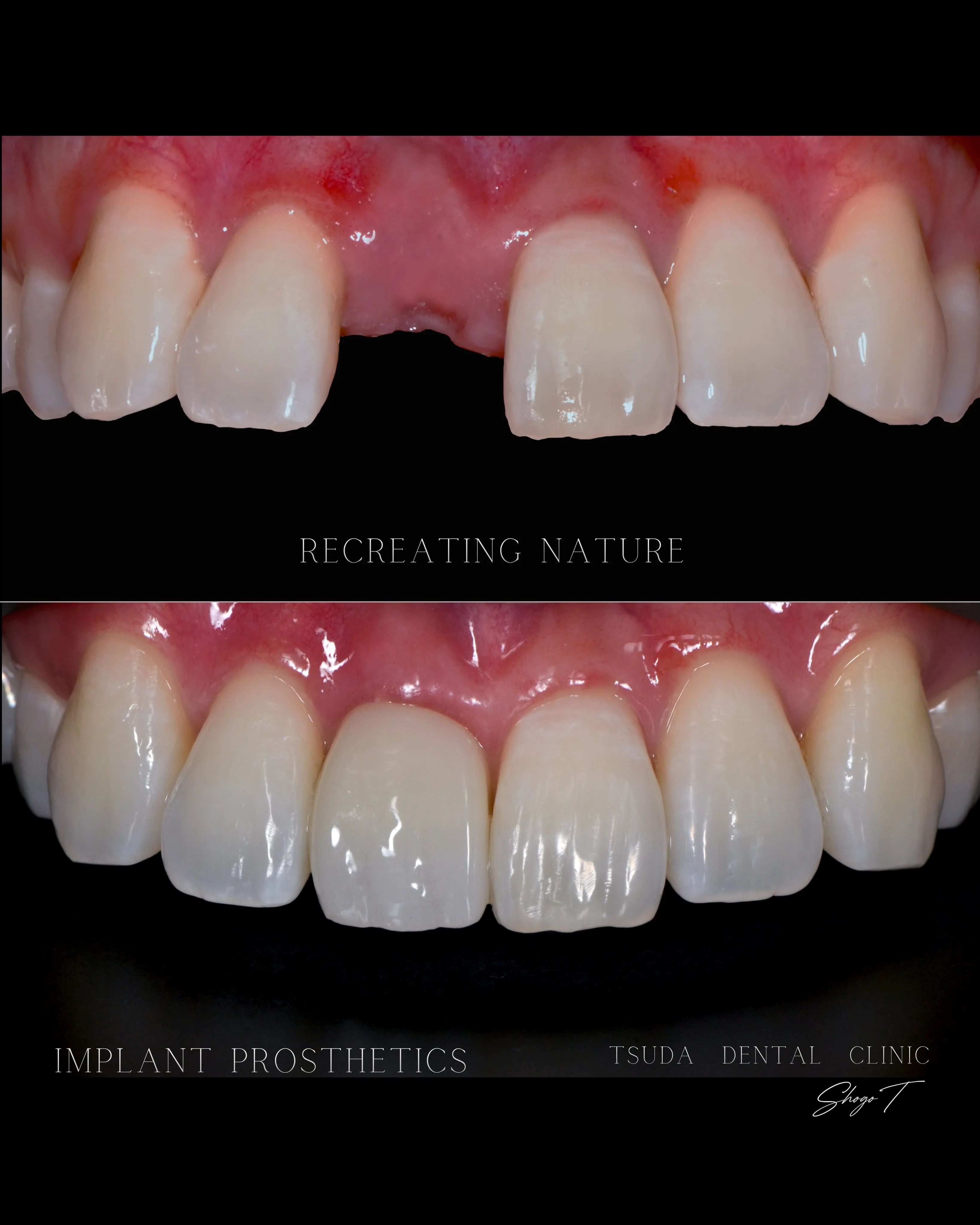 【Case Report: Anterior Implant...