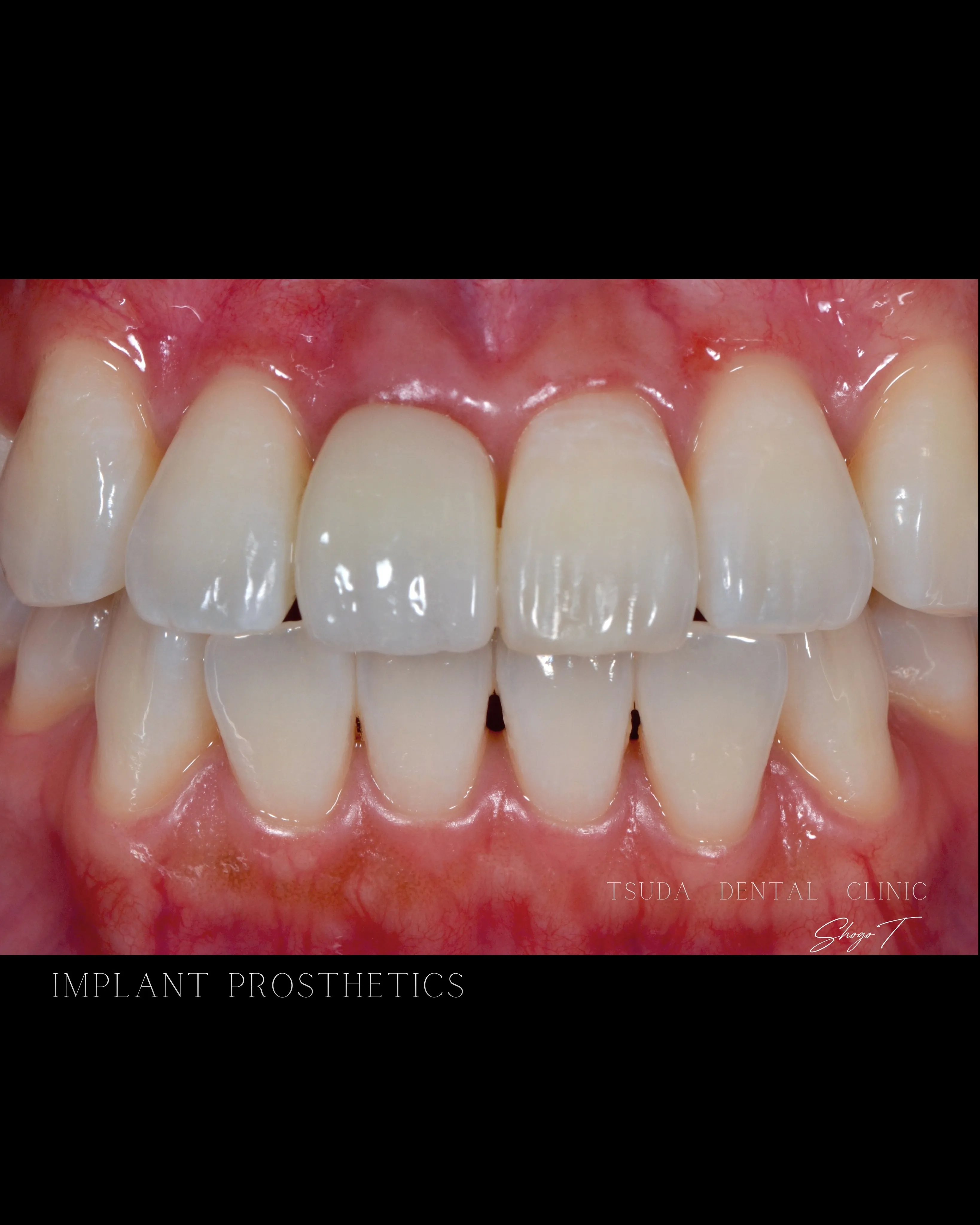 【Case Report: Anterior Implant...