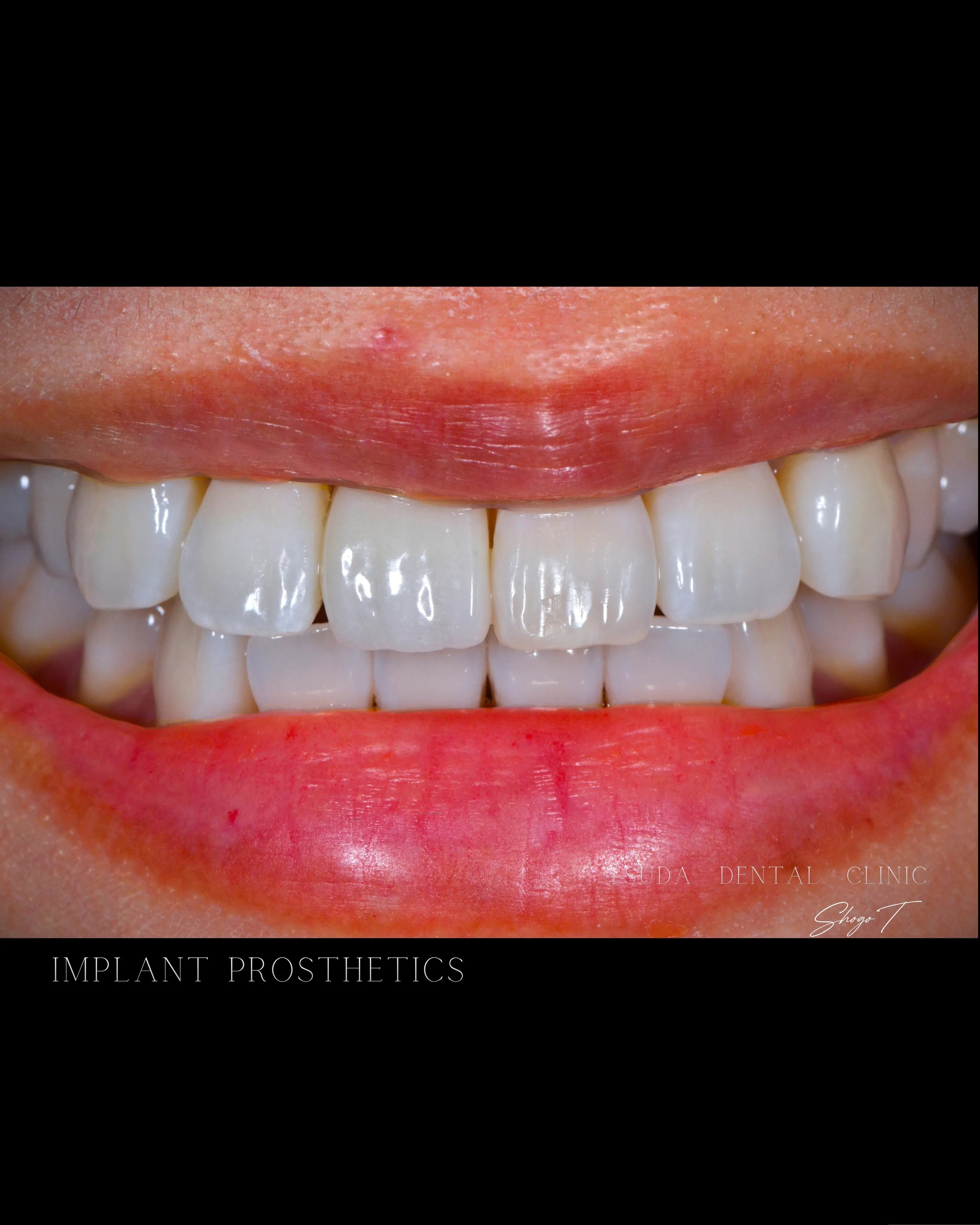 【Case Report: Anterior Implant...