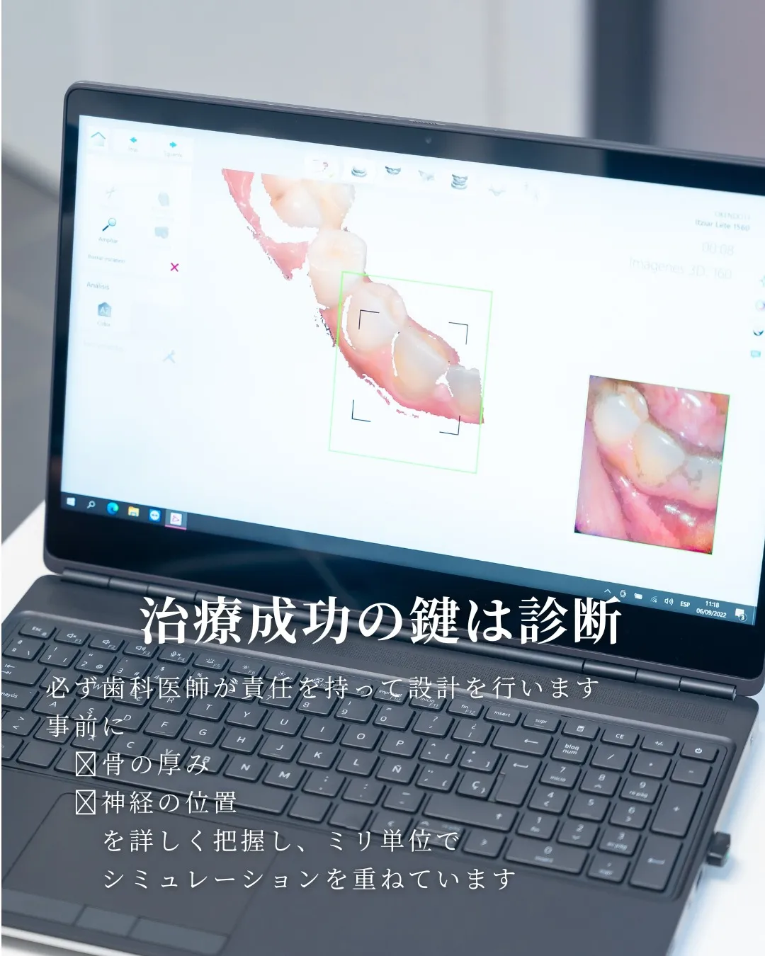 【インプラント治療について取材を受けました】