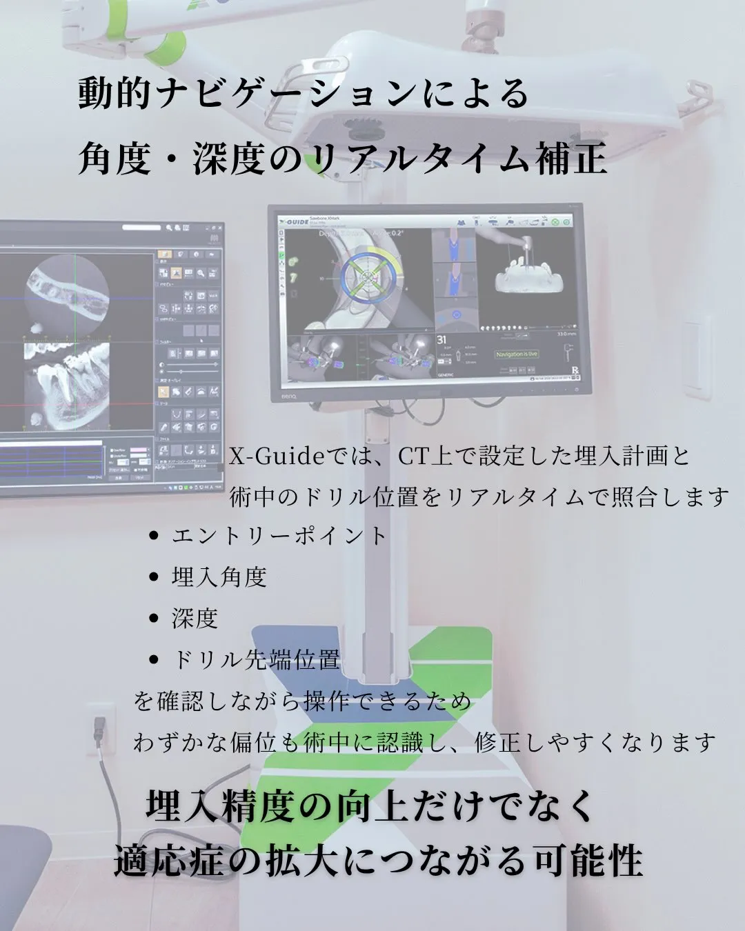 【X-Guideが広げるインプラント治療の可能性】