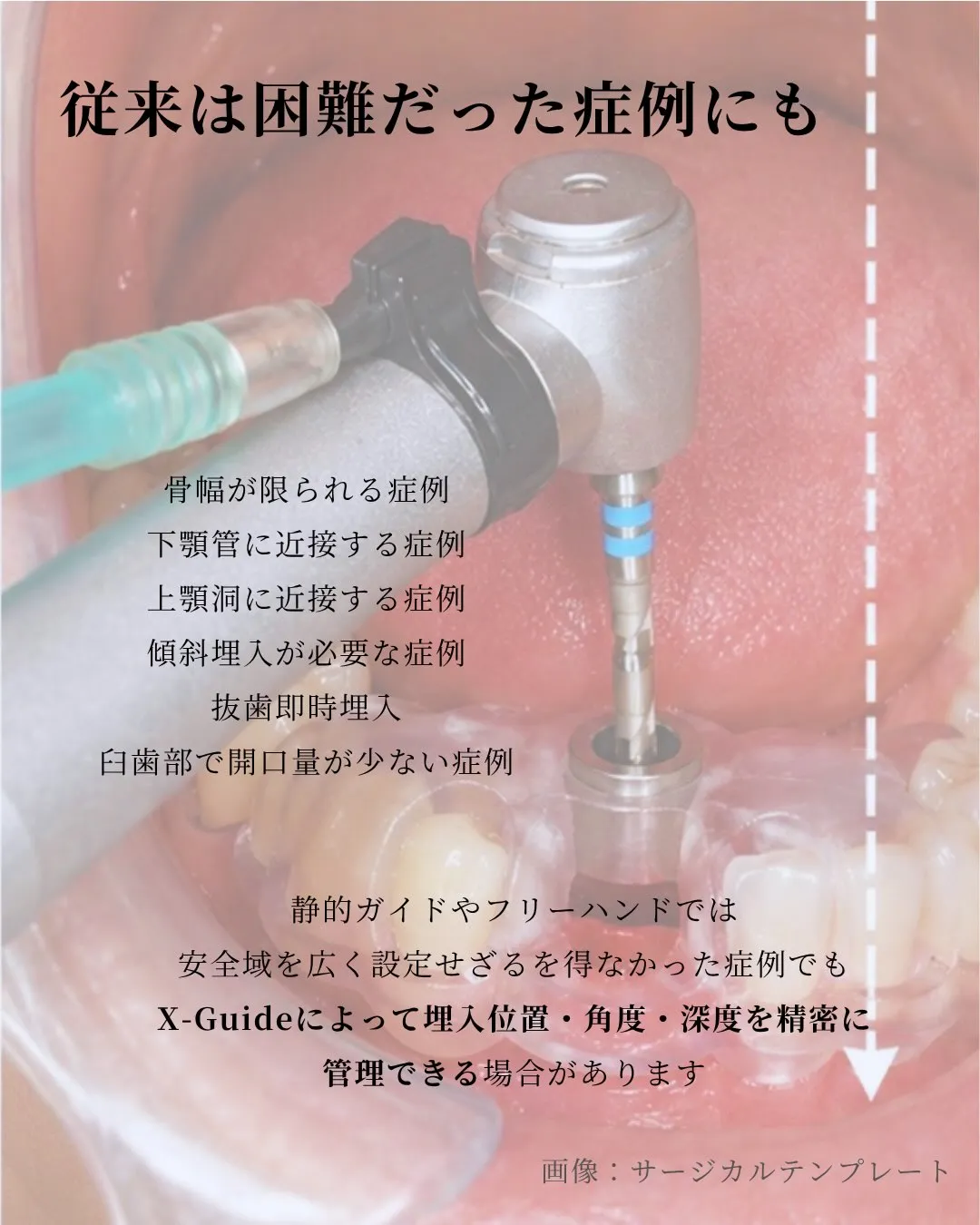 【X-Guideが広げるインプラント治療の可能性】