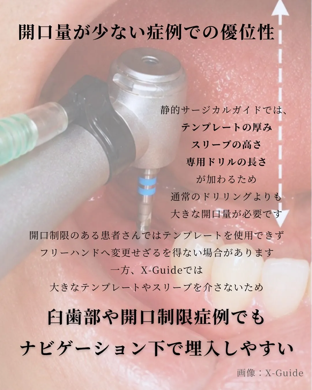 【X-Guideが広げるインプラント治療の可能性】