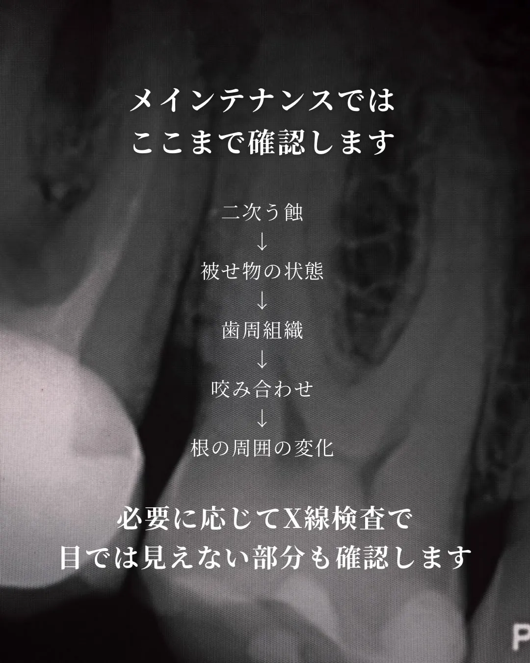 【神経を取った歯は危険⚠️?】