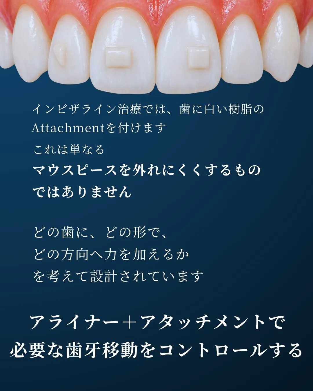 🦷【デジタル矯正|Invisalign編】