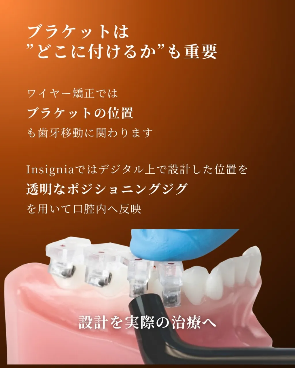 🦷【デジタル矯正|Insignia編】